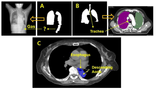 폐의 컨투어 정보를 담고 있는 데이터에서 폐 이외에 부분이 함께 Labling되어 있는 경우들（A: 위장내 가스, B: 기도) 혹은 서로 다른 두 기관이 하나의 컨투어로 표기된 데이터의 예시(C: 복부대동맥과 식도가 하나로 표기되어 있음)