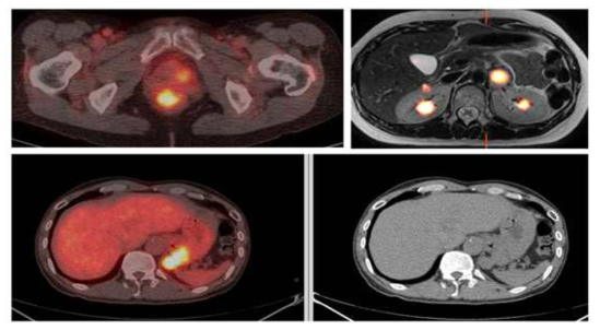 핵의학 영상 장치인 PET-CT 영상. 노란색 부분이 암으로 진단된 부위. 오른쪽 아래 CT 영상에서는 암으로 판별하기 어렵다