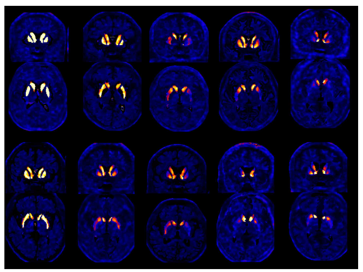 정상 패턴 및 파킨슨 패턴의 도파민운반체 밀도자료를 디지털 팬텀으로 제작