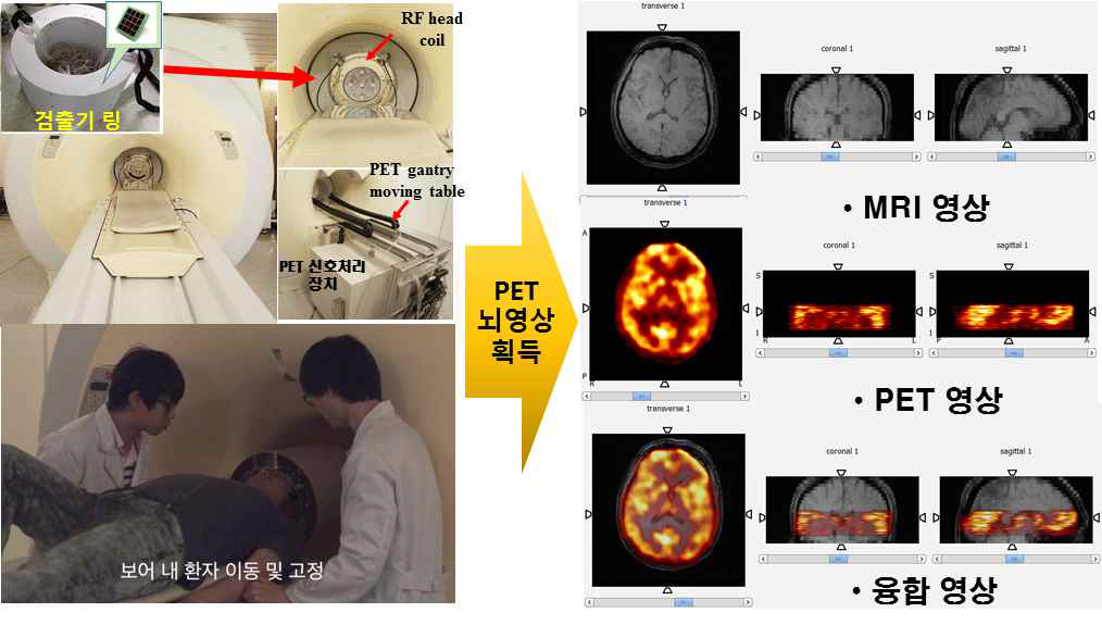 MR 호환 뇌전용 PET 개발 및 테스트 결과