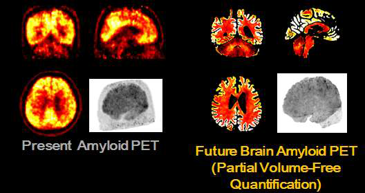 C-11 PIB PET 아밀로이드 영상획득 영상