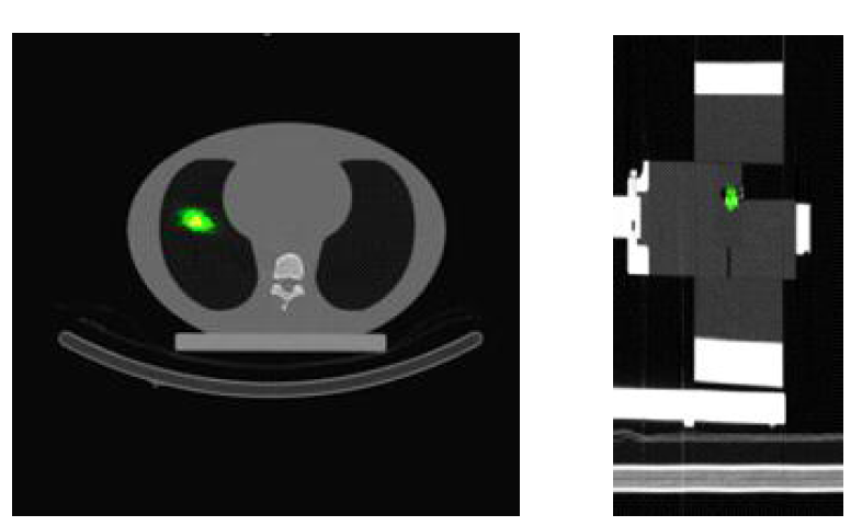 ML-EL으로 재건한 Emission tomography 영상과 CT 정합 영상(xy 평면과 xz평면)