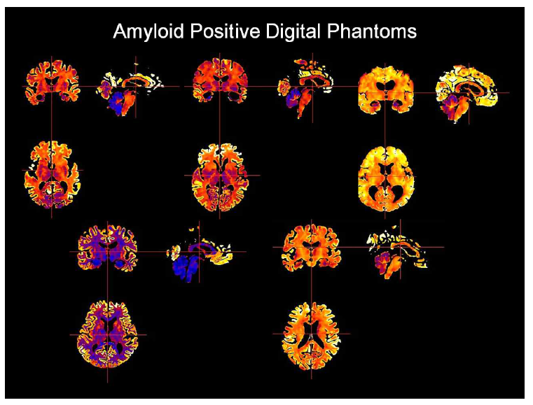 1차년도 수집 자료에 기반한 아밀로이드 PET 디지털 팬텀 예시 (음성)