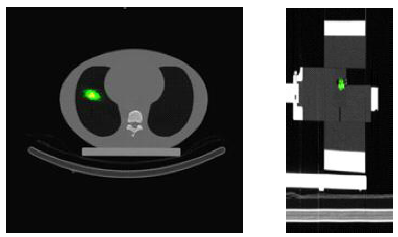 ML-EL으로 재건한 Emission tomography 영상과 CT 정합 영상(xy 평면과 xz평면)