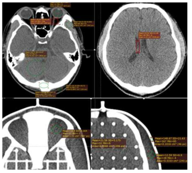 실제 환자와 CIRS MRI distortion phantom CT영상