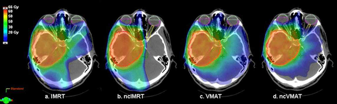 첨단 방사선치료기법의 환자 체내 방사선량 분포 예시, 뇌에 위치한 종양에 처방 방사선량을 전달하는 동시에 정상 장기 피폭을 최소화