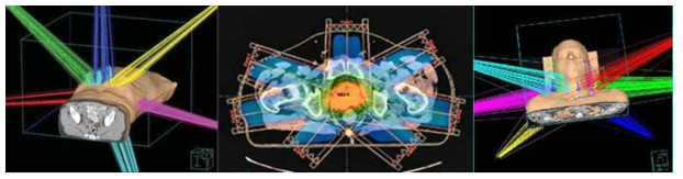 환자 3차원 해부학적 정보를 제공하는 의료영상에 방사선치료계획 수립 예