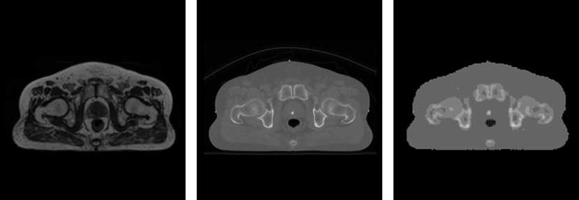 Prostate MR 영상, CT 영상, 10-level CT 영상