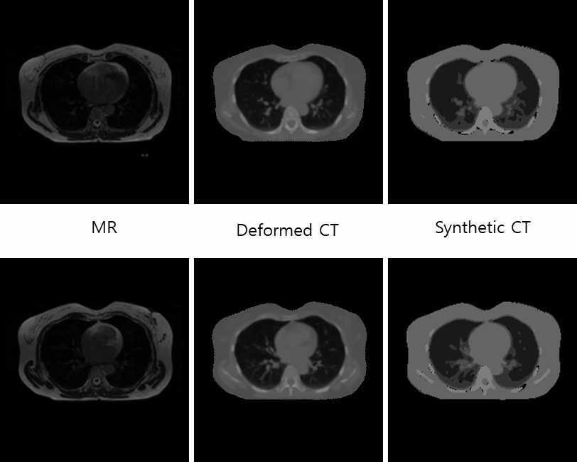 U-net을 이용하여 합성 CT를 생성한 결과