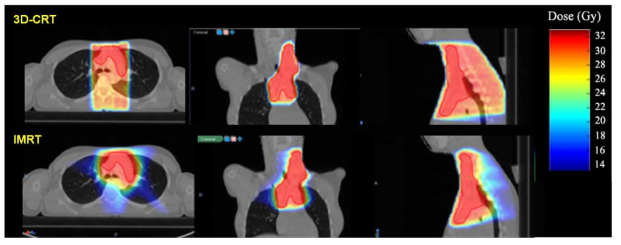치료기법에 따른 방사선량 분포(위: 3차원 입체조형 방사선치료, 아래: 체적조절호형방사선치료), 치료기법에 따른 환자 체 내 방사선량 분포를 계산하여 효과적인 종양제어 및 정상장기의 피폭 방지를 도모할 수 있음