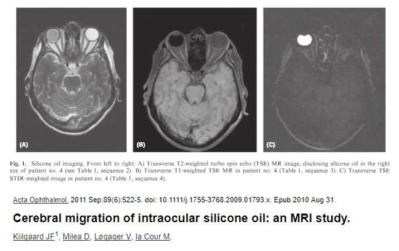 Silicone oil을 이용한 망막분리증 환자의 치료 및 MR 촬영 영상