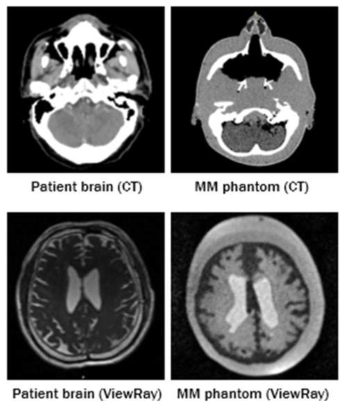 두경부 팬톰에 대한 MR(ViewRay)/CT 촬영영상