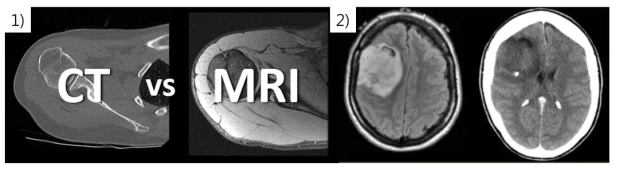 1) CT에 비해 MR영상은 연부조직의 대조능이 높음, 2) CT영상에서 명확하게 정의되지 않은 뇌종양(우)을 MR영상에서는 정확하게 정의할 수 있음(좌)