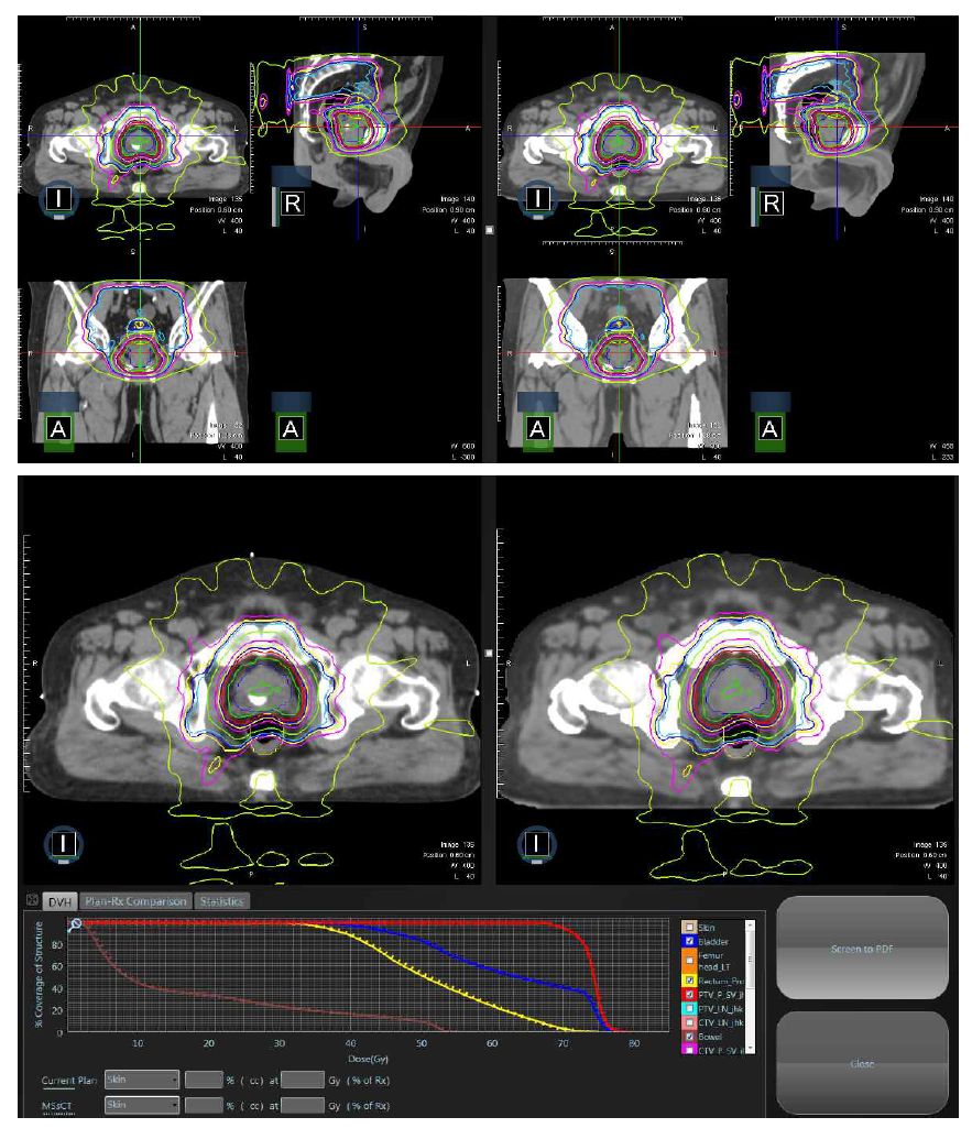 두 개의 치료계획에 대한 방사선량 분포 차이와 DVH 분석