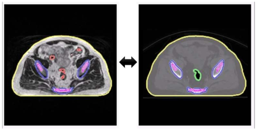 MR(좌)영상과 CT(우)영상에 조직별 윤곽선을 표시하여 비교