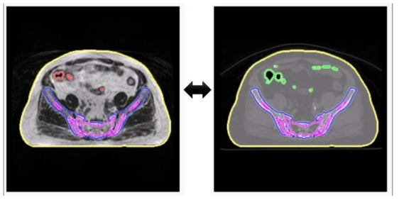 MR(좌)영상과 CT(우)영상에 조직별 윤곽선을 표시하여 비교