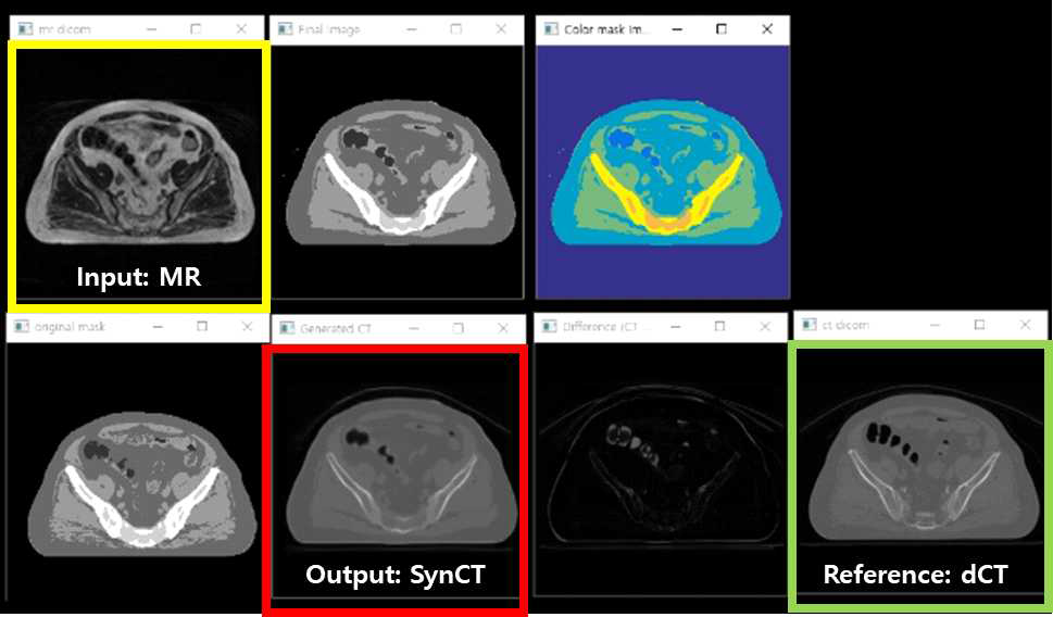 입력 MR에서 합성 CT를 생성하는 프로세스에 의해 생성된 중간 결과 이미지들