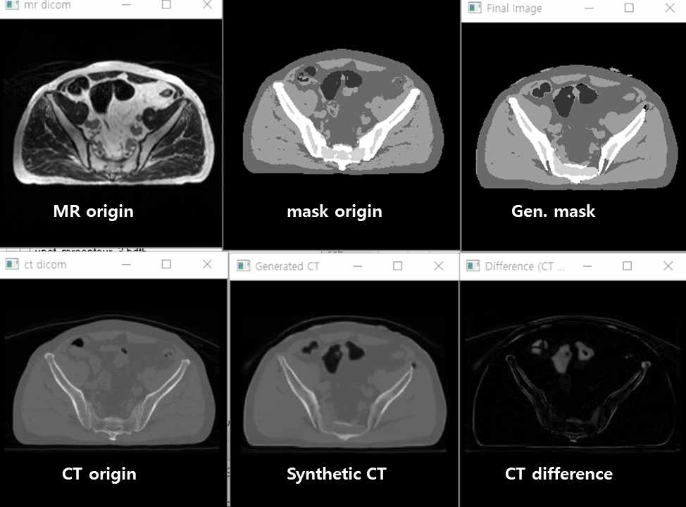 Prostate MR 영상을 입력하여 SynCT를 생성한 결과 (1)