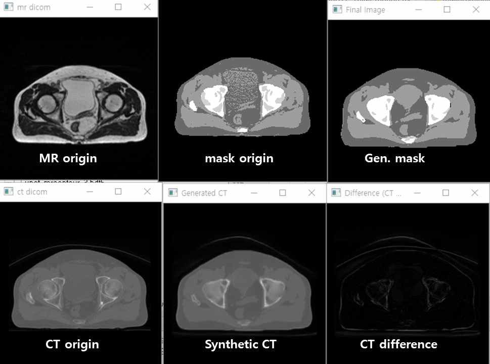 Prostate MR 영상을 입력하여 SynCT를 생성한 결과 (2)