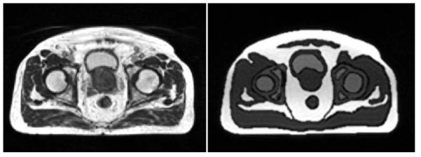 실제 환자 MR영상(좌), 팬톰 MR영상(우)