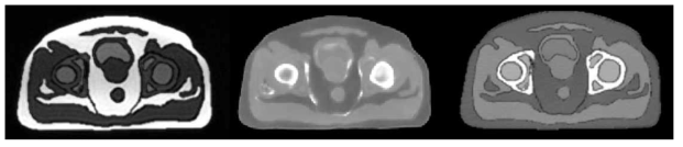팬톰의 MR 영상(좌), 합성 CT 생성 알고리즘으로 생성한 영상(중), 영상 실제 CT 영상(우)
