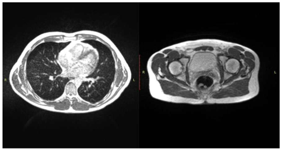 흉부(좌)와 골반부(우)의 뷰레이 시스템 3차원 MR영상