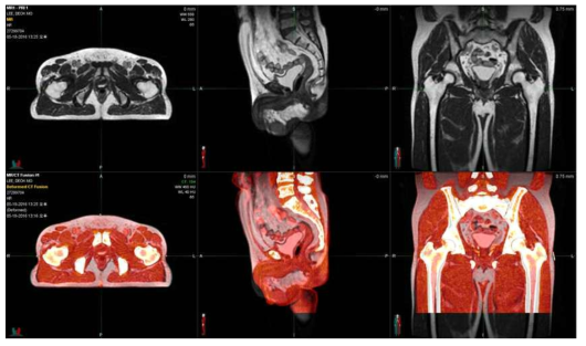 MIM 소프트웨어를 이용한 MR-CT 간 변형 영상 정합