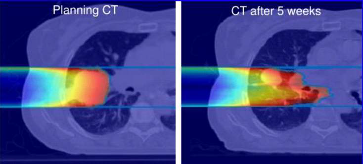 방사선치료 시, 환자 체형 변화 및 종양 크기 감소에 의한 CT영상의 차이로, 처방 방사선량 분포에 변화가 생길 수 있고, 이는 종양제어 실패 및 정상장기 심각한 피폭을 야기할 수 있음