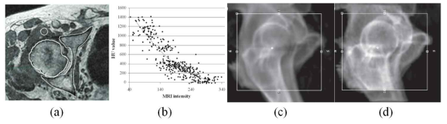 Kapanen M et al. (a) MR영상에서 수동으로 획득한 뼈 조직, (b) MR-CT 간 신호 비교. (c) 실제 CT영상으로 재구성한 DRR, (d) 합성CT영상으로 재구성한 DRR