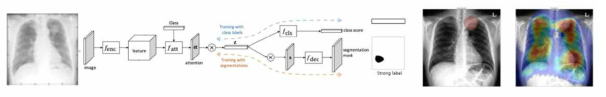 Weakly supervised learning 방식을 통해 자동으로 폐암의 위치를 예측