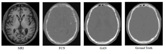 뇌 영상에 대한 MRI영상으로부터 생성된 합성 CT 영상들. FCN은 컨볼루셔널 신경망을 이용한 fully connected networks를 의미하며, GAN은 생성적 적대 신경망을 통해 합성된 CT 영상