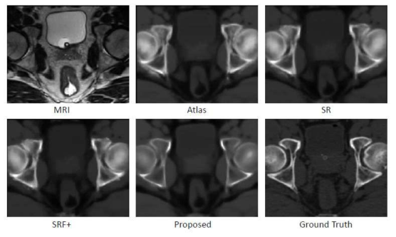 골반(pelvic)영상에 대한 MRI 영상으로부터의 합성 CT 생성 영상들. 논문에서 제안한 연구가 실제 CT와 가장 유사하게 표현됨