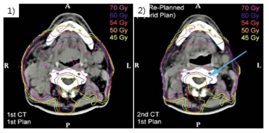환자 체중변화로 인한 방사선량 분포의 변화, 1) 환자에게 전달하고자 의도한 방사선량 분포, 2) 환자 치료 중, 환자 체중 감소(12% 체중 감소)로 인한 방사선량 분포의 변화, 의도한대로 방사선량이 환자에게 전달되지 않아 암 치료 실패 및 정상 장기의 과피폭으로 인한 합병증이 예상됨
