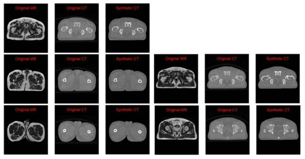가상 CT 생성의 선행연구결과 성공 예시