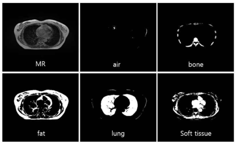 CT number를 기준으로 5가지 조직으로 분리한 dCT 영상들