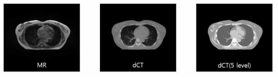 Breast 환자의 MR 영상과 dCT 영상, 그리고 5가지 조직으로 구분한 dCT 영상 예시