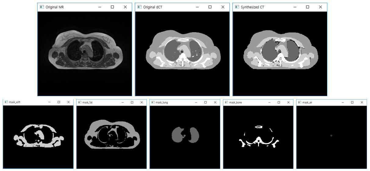 5개의 딥러닝 모델을 거쳐 생성된 마스크 이미지들을 조합하여 최종 합성CT를 생성함(top-rightmost)
