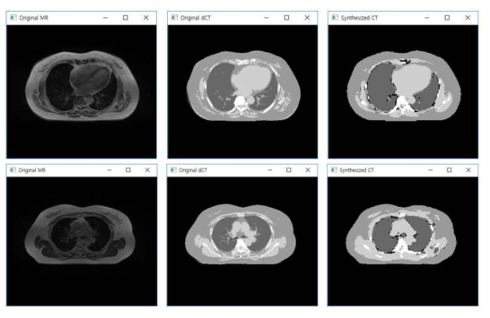 테스트 환자의 MR 영상에 대한 합성CT와 원본CT 영상 비교 결과