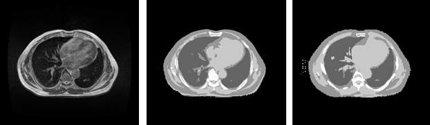 Abdomen 영역의 원본 MR, 원본 5-level dCT, 합성CT(5-level)