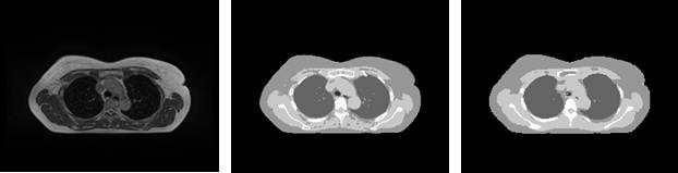 Breast 영역의 원본 MR, 원본 5-level dCT, 합성CT(5-level)