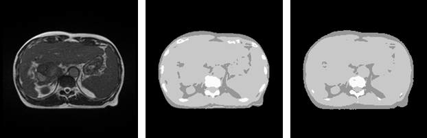 Liver 영역의 원본 MR, 원본 5-level dCT, 합성CT(5-level)