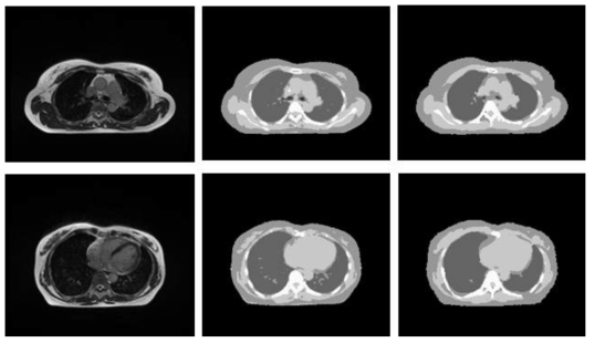 Lung 영역의 원본 MR, 원본 5-level dCT, 합성CT(5-level)