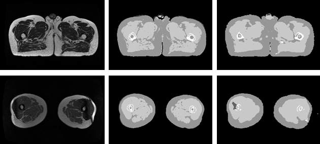 Prostate 영역의 원본 MR, 원본 5-level dCT, 합성CT(5-level)