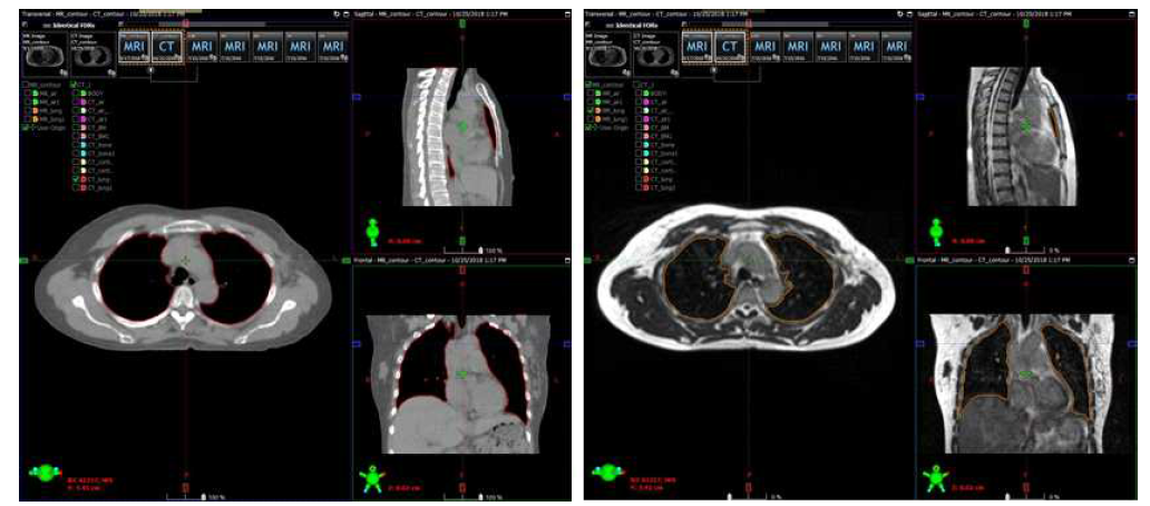 폐암환자 CT와 MR 영상에서의 폐 영역 부분 윤곽선 추출