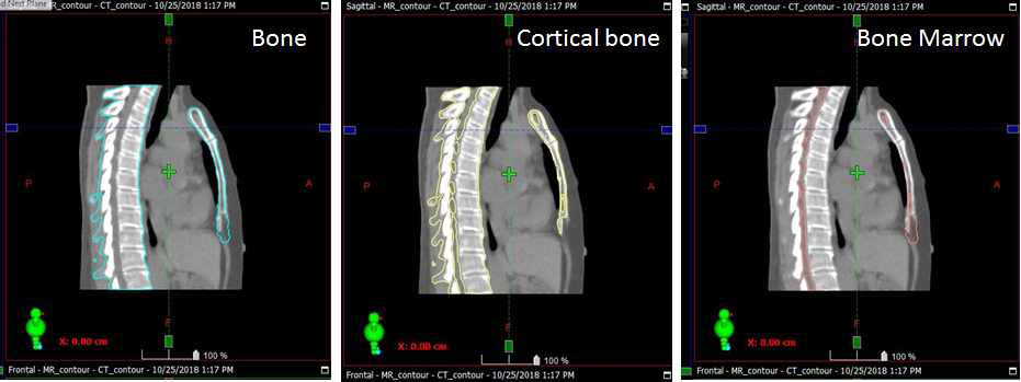 폐암환자 CT와 MR 영상에서의 뼈 영역 부분 윤곽선 추출