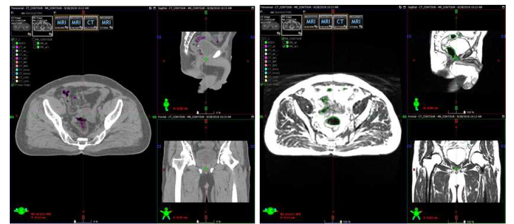 전립선암환자 CT와 MR 영상에서의 공기 영역 부분 윤곽선 추출
