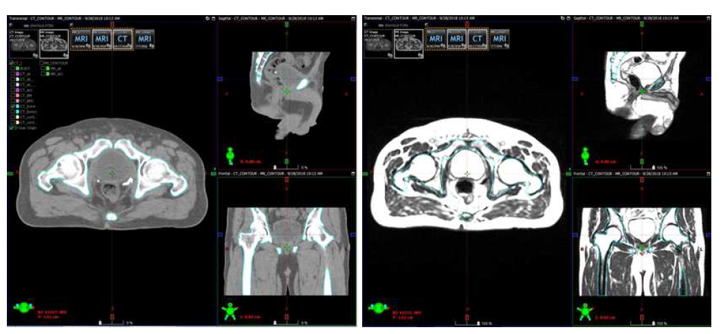 전립선암환자 CT와 MR 영상에서의 뼈 영역 부분 윤곽선 추출