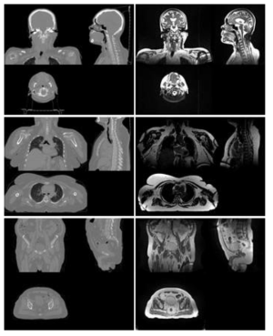 (위)두경부암 (중간)폐암 (아래)전립선암에 대한 SKSH CT-MR 데이터셋