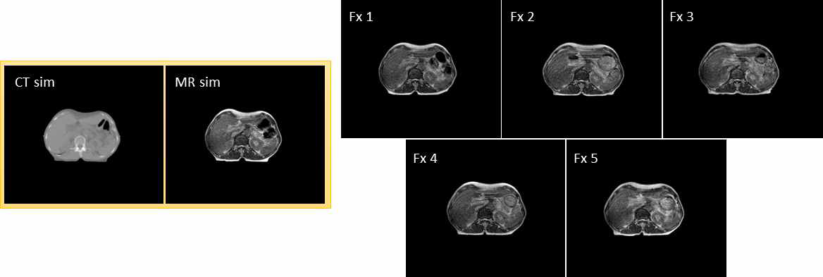 SMART에서의 획득한 CT, MR 영상. 매 분할 치료 시 마다 환자의 위치 및 장기 변화가 관찰됨