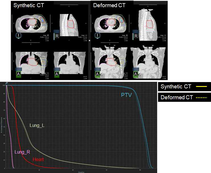 합성CT와 변형CT을 사용한 치료계획에서의 선량체적히스토그램 비교 (폐암)